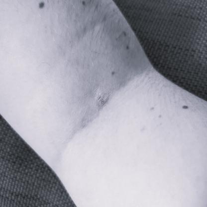 An arm with a scar at the point of where the needle went in